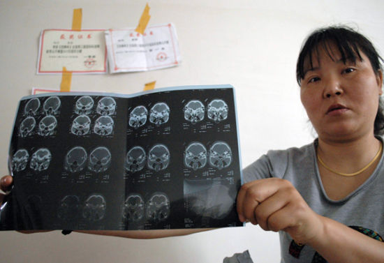 学生被老师打耳光右耳鼓膜充血致听力下降