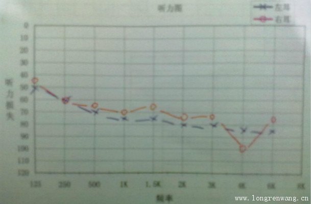 峰力助听器奥迪智通S 1 开放耳验配案例