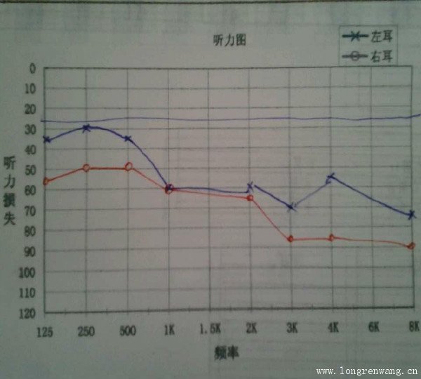 西门子助听器“莲花12P”验配案例