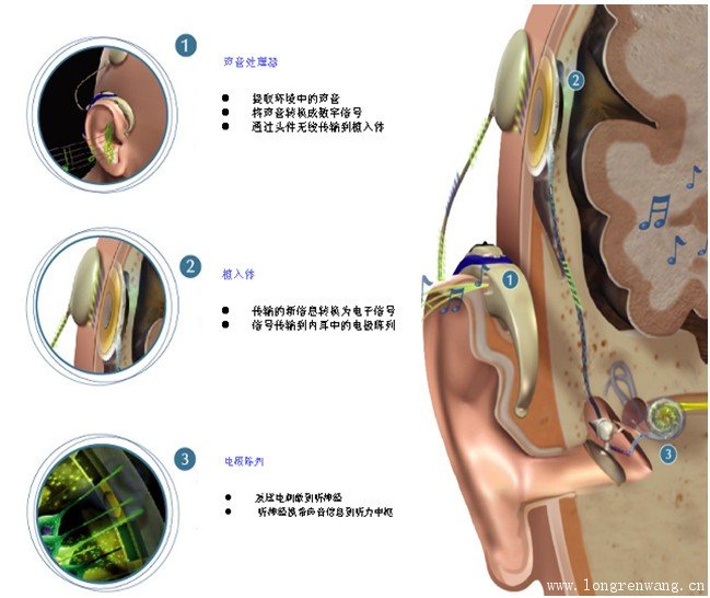 电子耳蜗基本组成图