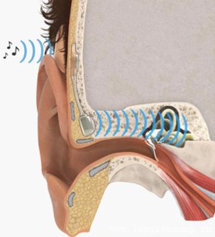 骨传导助听器可取代中耳使聋人恢复听力