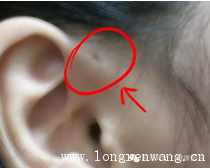 听力健康 · 耳科·耳前瘘管