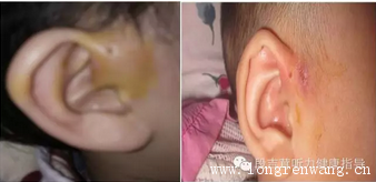 听力健康 · 耳科·耳前瘘管